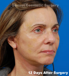 Female face, 12 days after facelift recovery treatment, r-side oblique view