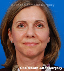 Female face, one month after facelift recovery treatment, front view