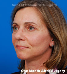 Female face, 1 month after facelift recovery treatment, l-side oblique view