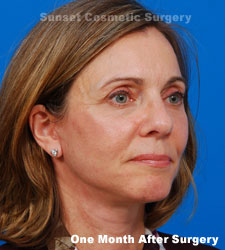 Female face, one month after facelift recovery treatment, l-side oblique view