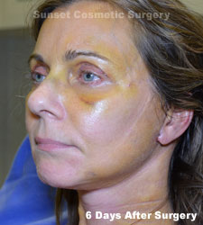 Female face, 6 days after facelift recovery treatment, l-side oblique view