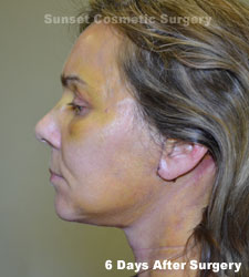 Female face, 6 days after facelift recovery treatment, l-side view