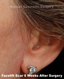 Female face, 6 weeks after facelift recovery surgery, l-side oblique view (ear)