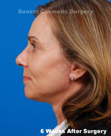Female face, 6 weeks after facelift recovery surgery, l-side view