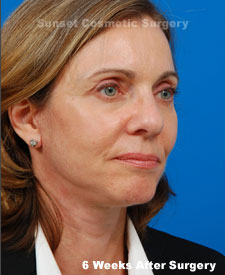 Female face, 6 weeks after facelift recovery surgery, r-side oblique view