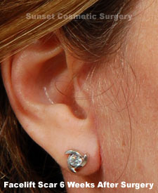 Female face, 6 weeks after facelift recovery surgery, r-side oblique view (ear)