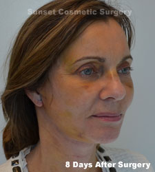 Female face, 8 days after facelift recovery treatment, r-side oblique view