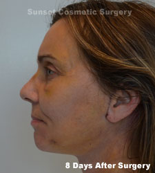 Female face, 8 days after facelift recovery treatment, l-side view