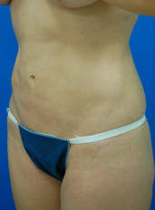 Female body, before Liposuction and Revision treatment, oblique view, patient 1
