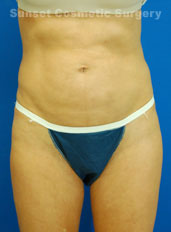 Female body, after Liposuction and Revision treatment, front view, patient 1