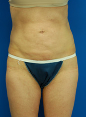 Female body, before Liposuction and Revision treatment, front view, patient 1