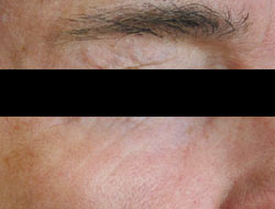 Male face, after portrait plasma facial treatment, oblique view