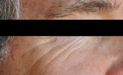 Male face, before portrait plasma facial treatment, oblique view