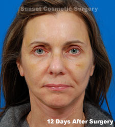 Female face, 12 days after facelift recovery treatment, front view