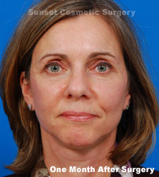 Female face, 1 month after facelift recovery treatment, front view