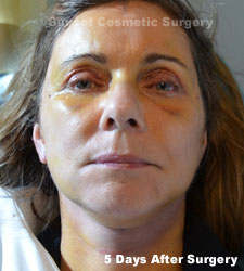 Female face, 5 days after facelift recovery treatment, front view