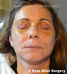 Female face, 5 days after facelift recovery treatment, front view (eyes closed)
