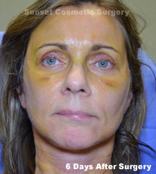 Female face, 6 days after facelift recovery treatment, front view (eyes open)