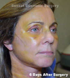 Female face, 6 days after facelift recovery treatment, r-side oblique view