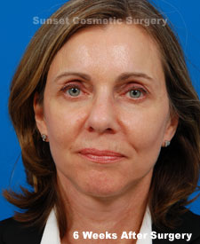 Female face, 6 weeks after facelift recovery treatment, front view