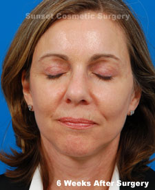 Female face, 6 weeks after facelift recovery treatment, front view (eyes closed)