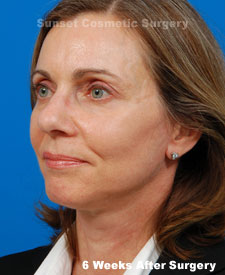 Female face, 6 weeks after facelift recovery surgery, l-side oblique view