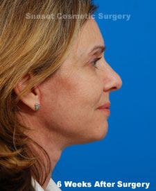 Female face, 6 weeks after facelift recovery surgery, r-side view