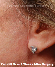 Female face, 6 weeks after facelift recovery surgery, l-side view (ear)