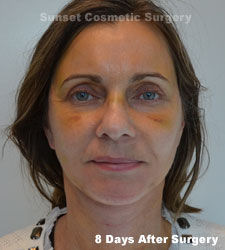 Female face, 8 days after facelift recovery treatment, front view