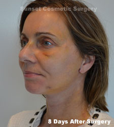 Female face, 8 days after facelift recovery treatment, l-side oblique view