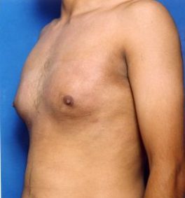 Male body, after Gynecomastia: Male Breast Reduction treatment, l-side oblique view, patient 1