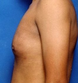 Male body, after Gynecomastia: Male Breast Reduction treatment, l-side view, patient 1