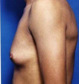 Male body, before Gynecomastia: Male Breast Reduction treatment, l-side view, patient 1