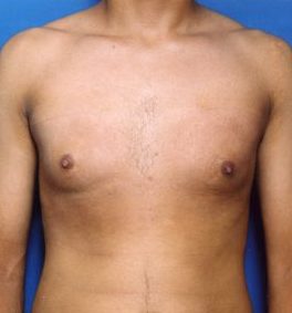 Male body, after Liposuction For Men treatment, front view, patient 1