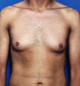 Male body, before Liposuction For Men treatment, front view, patient 1