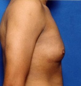 Male body, after Gynecomastia: Male Breast Reduction treatment, r-side view, patient 1