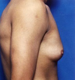 Male body, before Gynecomastia: Male Breast Reduction treatment, r-side view, patient 1