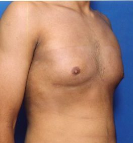 Male body, after Liposuction Revision treatment, r-side oblique view, patient 2