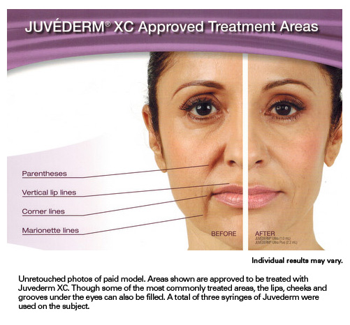 Juvederm XC Approved Treatment Areas. Before and After