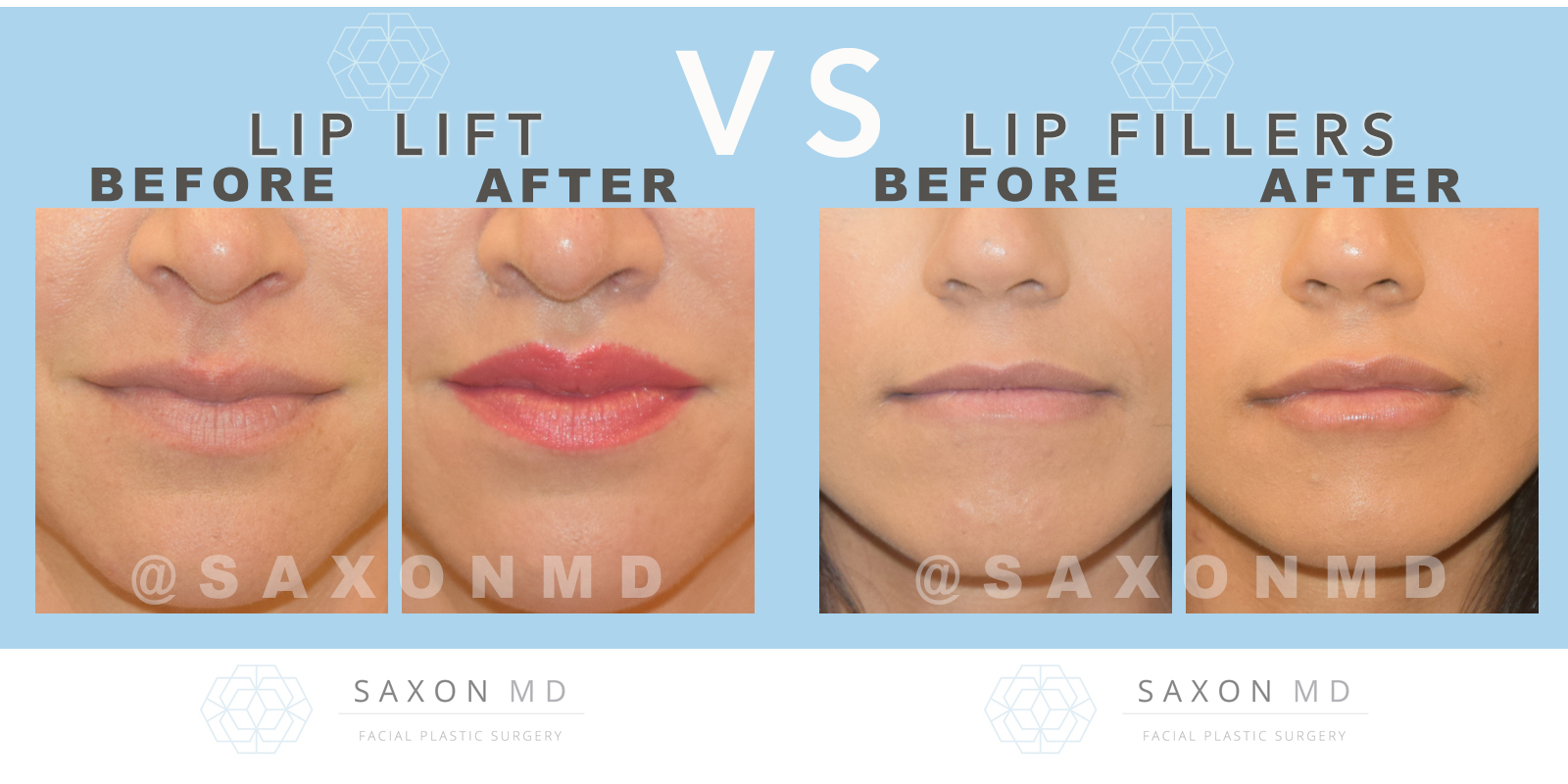 LIP LIFTS vs LIP REDUCTIONS - before and after treatment SAXON MD