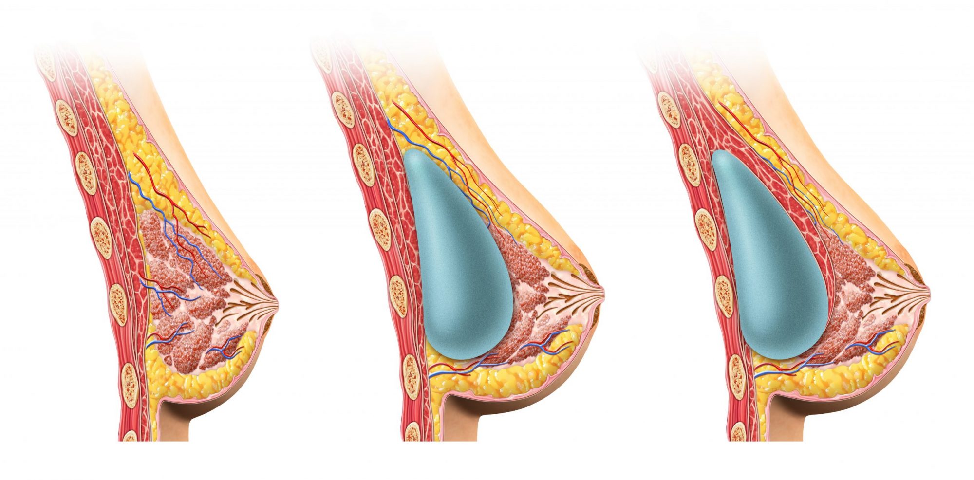  breast implant infographic before after sunset cosmetic surgery