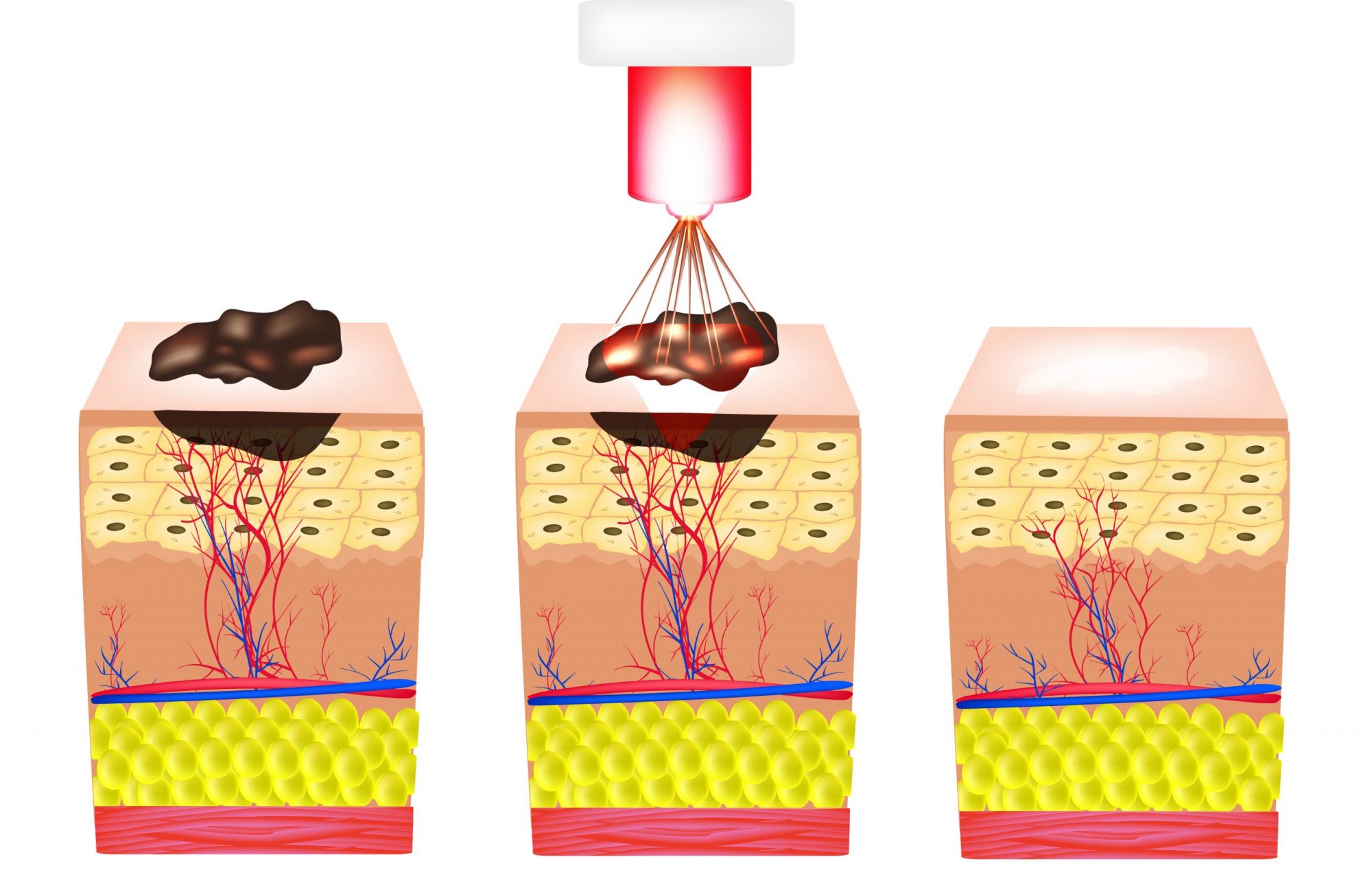 Mole Removal Process Cosmetic Surgery Los Angeles.j