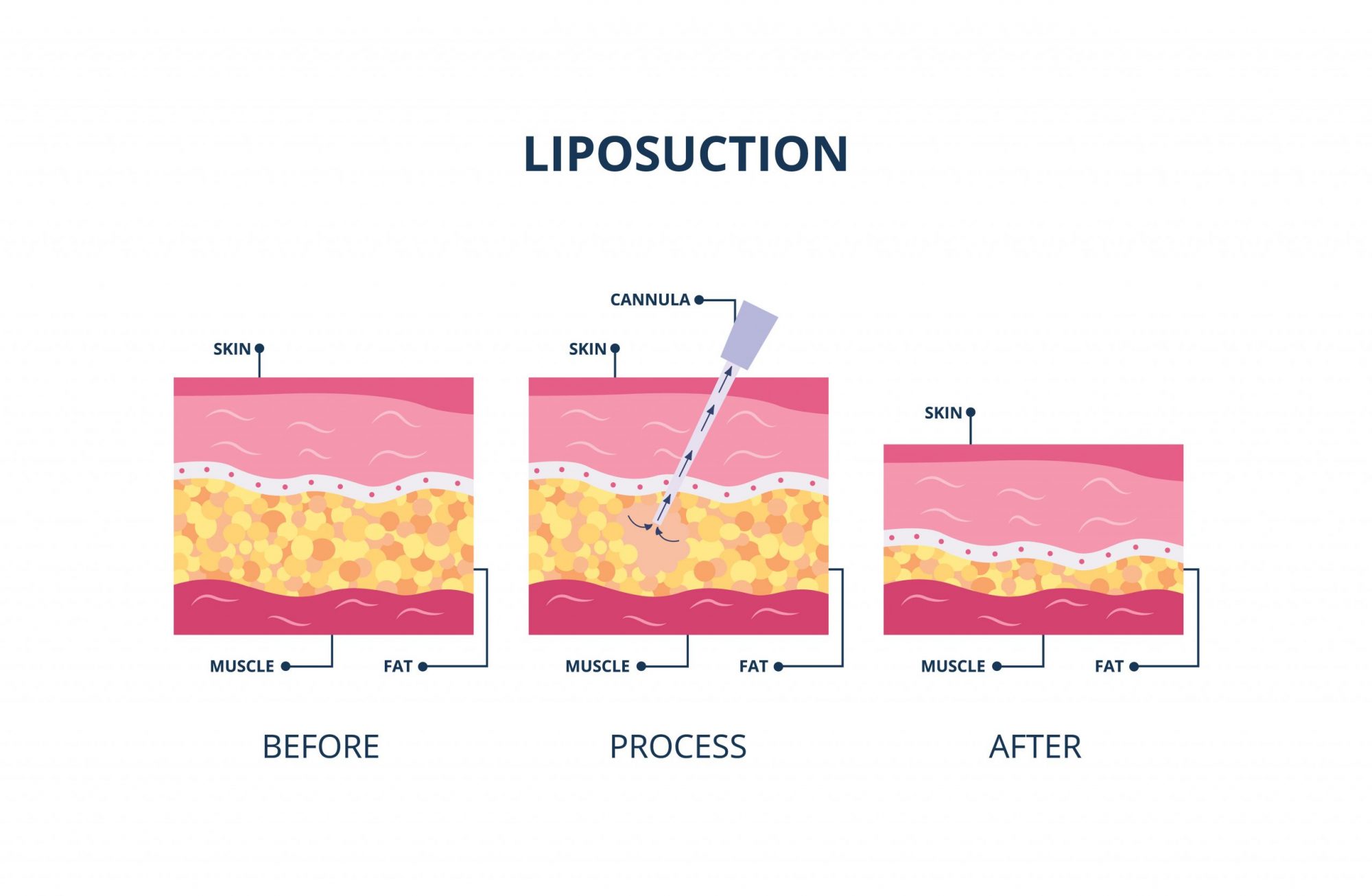 How is Fat Loosened for Removal Via Liposuction? | Sunset Cosmetic Surgery