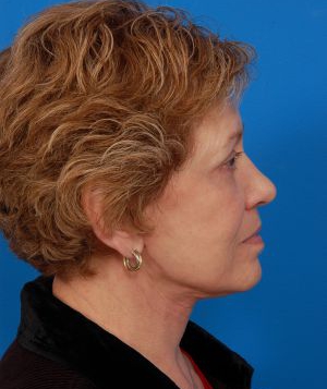 Woman's face, after Facelift treatment, r-side view, patient 11