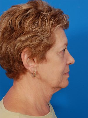 Woman's face, before Facelift treatment, r-side view, patient 11