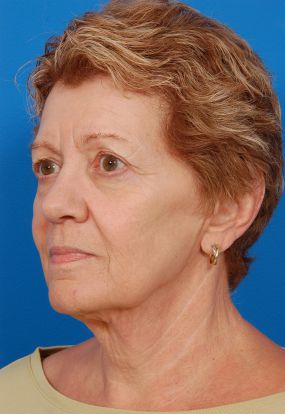 Woman's face, before Facelift treatment, l-side oblique view, patient 11