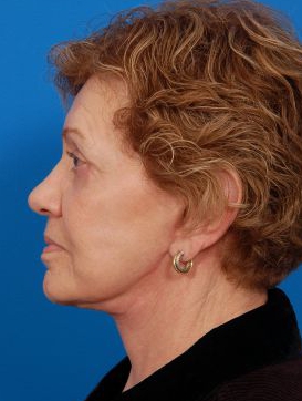 Woman's face, after Facelift treatment, l-side view, patient 11