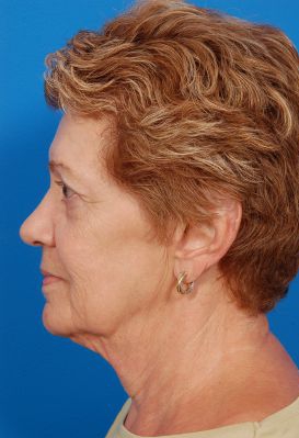 Woman's face, before Facelift treatment, l-side view, patient 11