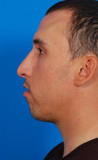 Male face, before Chin Implant treatment, l-side view of head, patient 94