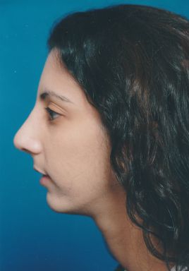 Female face, after Chin Implant treatment, l-side view, patient 4
